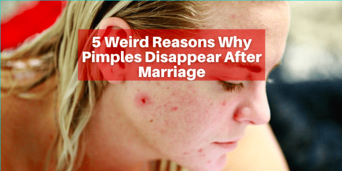 5 Weird Reasons Why Pimples Disappear After Marriage