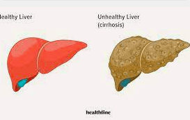 treats cirrhosis of the liver