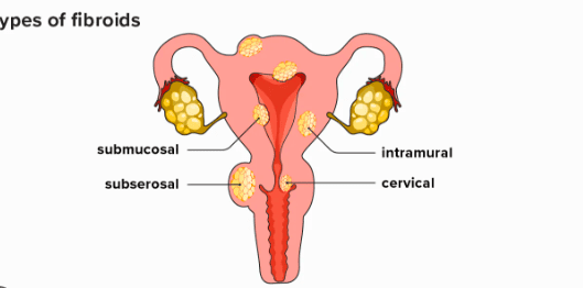 The Impact of Fibroids in the Uterus