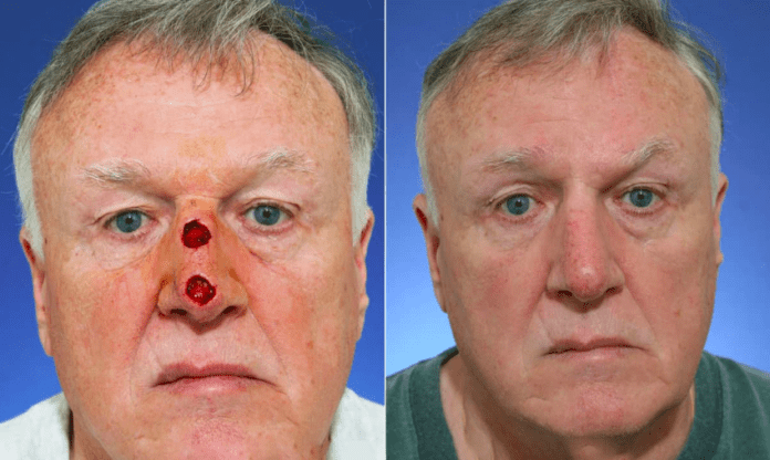 Treatment of Nose Cancer