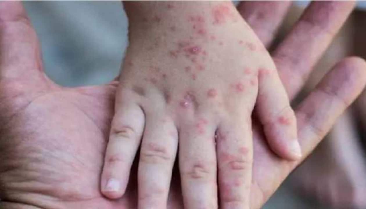 Does The Monkeypox Virus Do To Humans