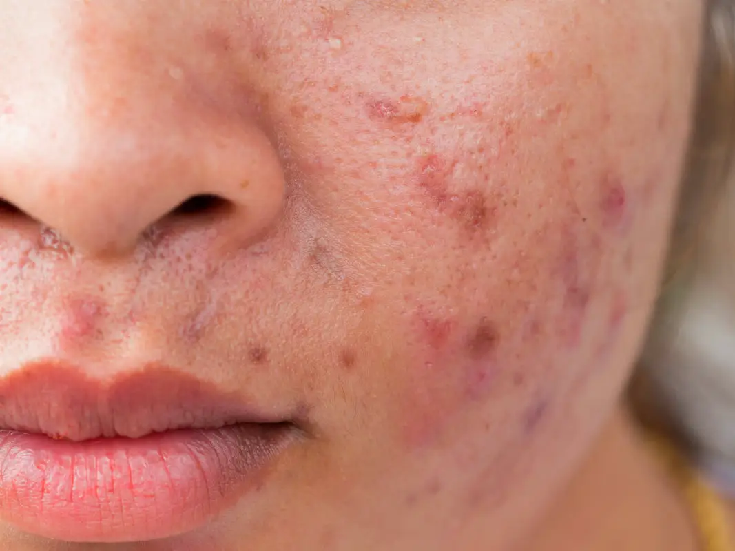 What causes pimples and why do they leave dark spots behind?