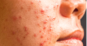 acne is a genetic and hormonal problem