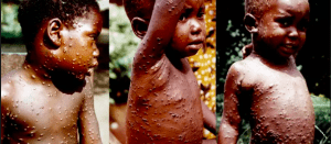 what are the symptoms of monkeypox?