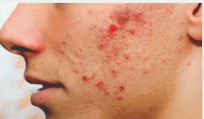 How common are blind pimples?