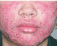 how are blind pimples diagnosed?