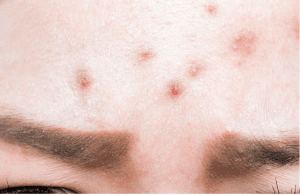 are forehead pimples dangerous?