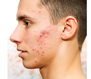 causes of dark spots caused by pimples