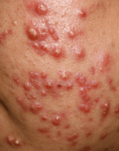 what are the signs and symptoms of acne?