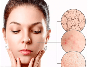 reduce inflammation and get rid of pimples