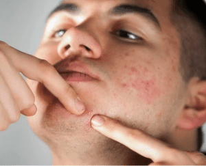 what causes a pimple to form?