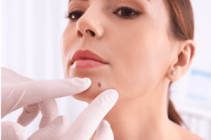 can pimples turn into moles?