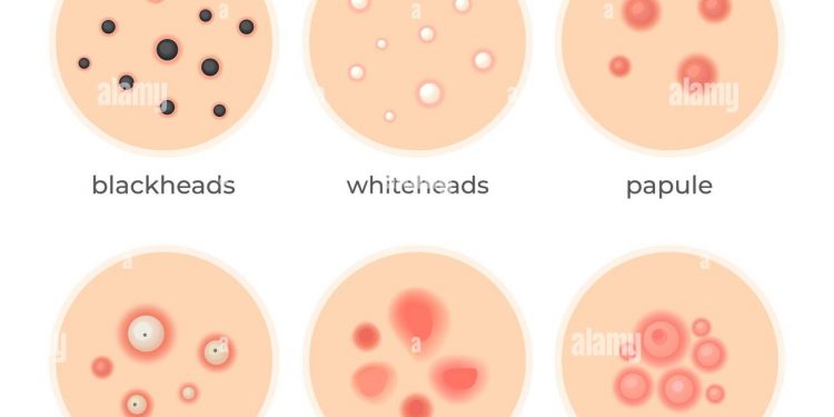 what are the different types of pimples?