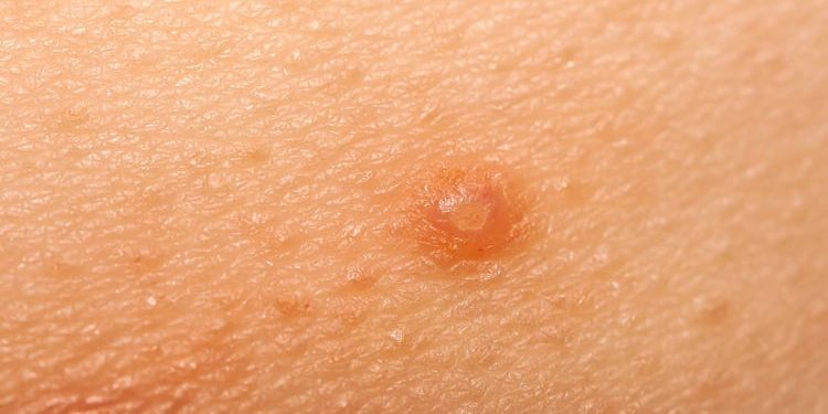 why are pimples itchy?