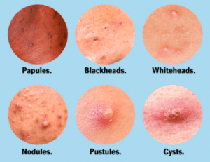 types of pimples and their causes