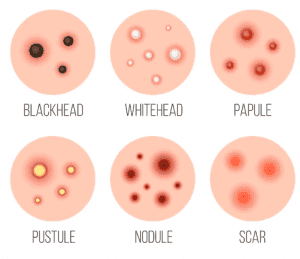 there are three types of pimples - blackheads, whiteheads, and cysts.