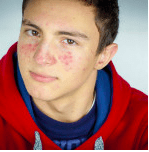 will pimples go away after puberty? here's what you need to know