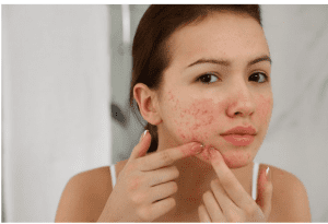 Will pimples go away after puberty?