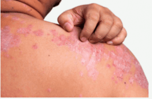 causes of itchy and painful pimples