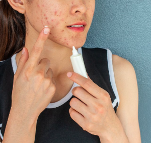 causes of pimples and their turn into warts