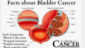 Bladder cancer: what are the main causes?