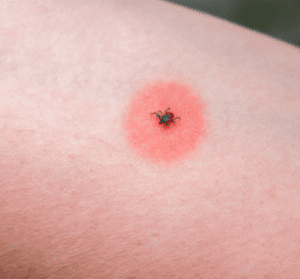 what are the different types of tick diseases?