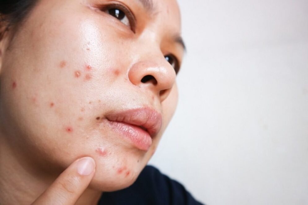Pimples: do they go away on their own? here's what you need to know