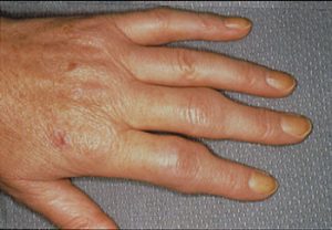 what are usually the first signs of rheumatoid arthritis?
