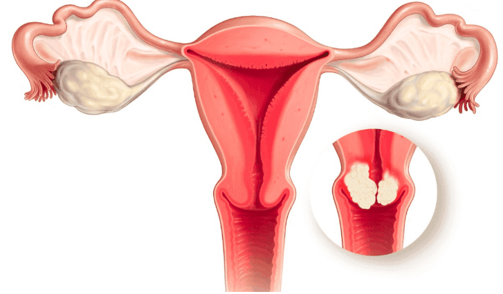 HPV and Uterine Cance