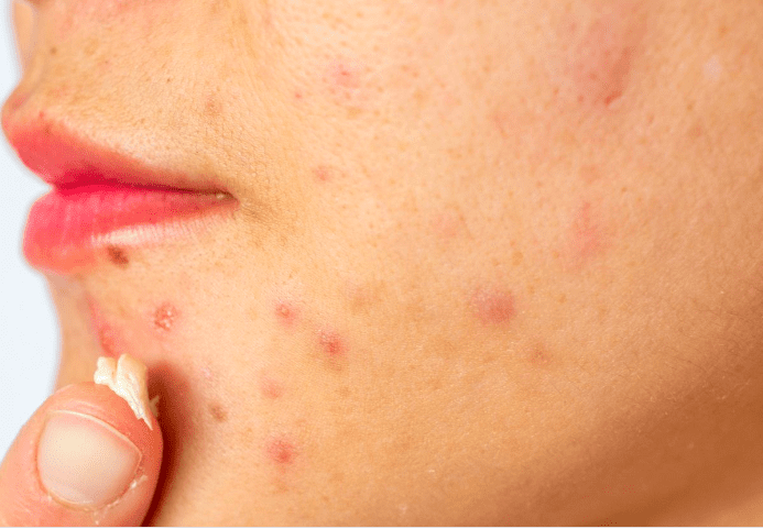 The Science of Pimples