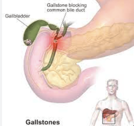 Gallstones Recur After Surgery