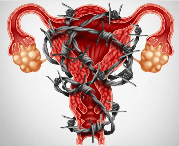 Research Links Endometriosis to a Common Bacteria