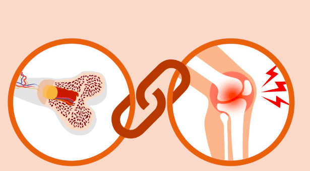 Arthritis and Osteoporosis Connected