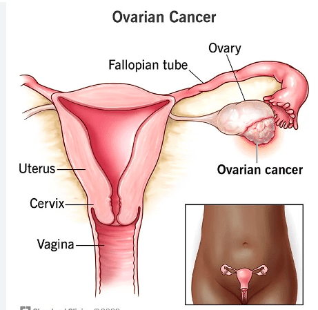 Understanding Ovarian Cysts