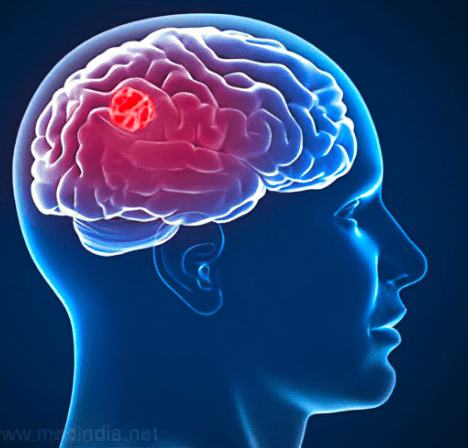 Can Brain Tumors Kill