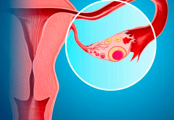Understanding the Causes of Ovarian Cysts