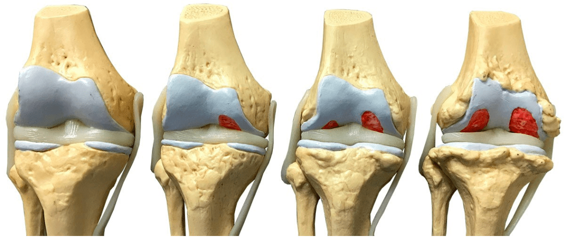 Experience of Arthritis in the Knee