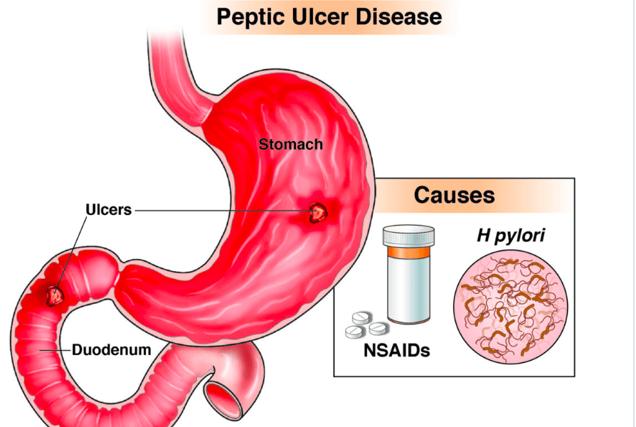 Peptic Ulcers and Stomach Cancer
