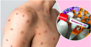 Best Home Remedies for Monkeypox