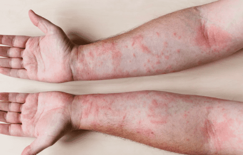 Treatment of Eczema in Adults