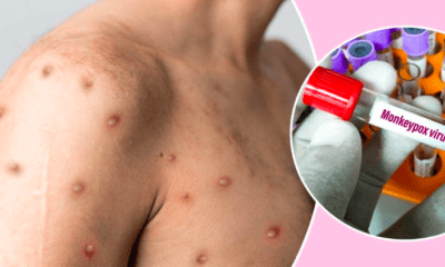 monkeypox rash
