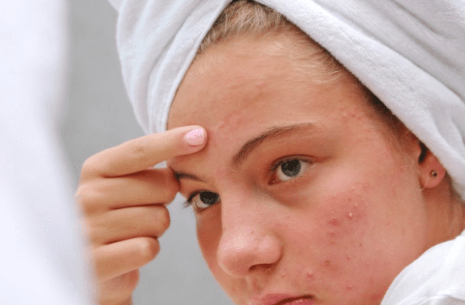 At What Age Do Pimples Stop