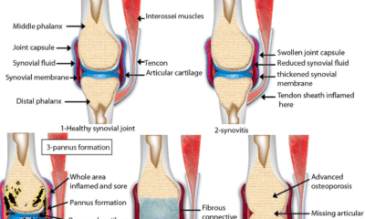 arthritis and rheumatoid arthritis
