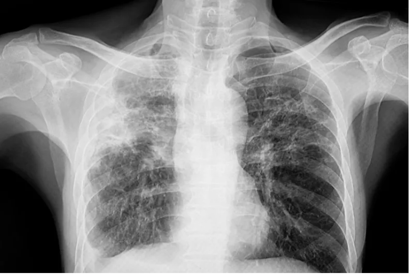 Tuberculosis Cases Are Surging in California
