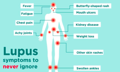 the Root Cause of Lupus