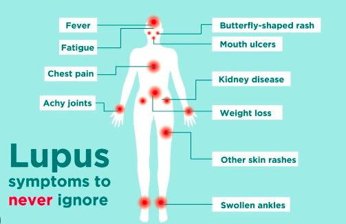 the Root Cause of Lupus