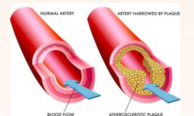 the Causes of Diabetes and Atherosclerosis