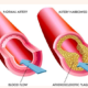 the Causes of Diabetes and Atherosclerosis