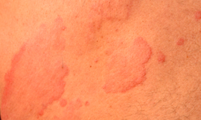 the Causes of COVID Hives