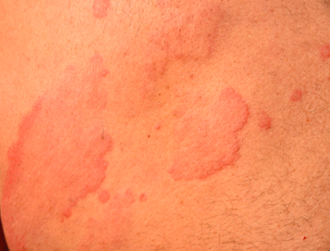 the Causes of COVID Hives